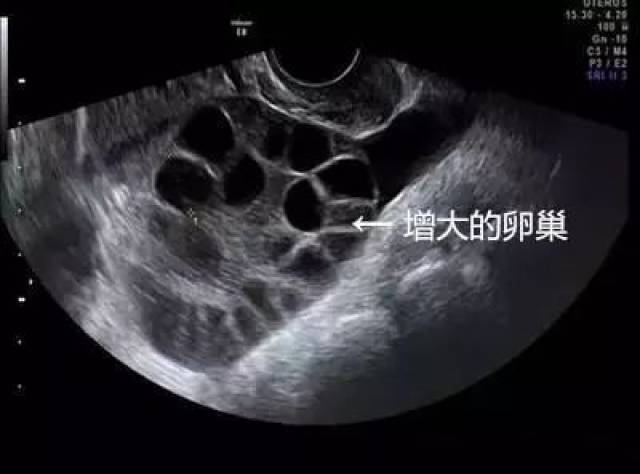 卵泡位置不佳导致取卵困难，挑战与对策