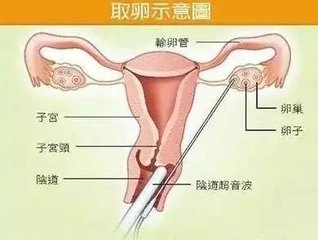 取卵后几天可以移植，全面解析试管婴儿的胚胎移植时间