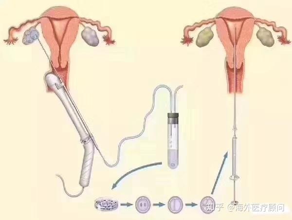试管婴儿之路，关于取卵过程中的疼痛感受